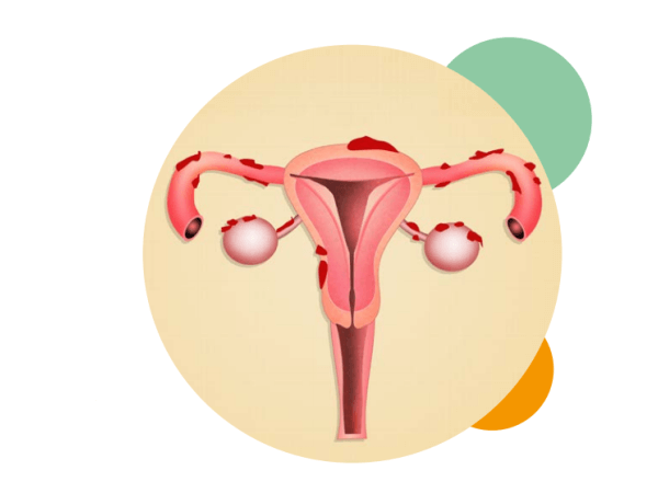 endometriose doença da mulher moderna - Dra Milla Cerqueira - Ginecologista Florianópolis