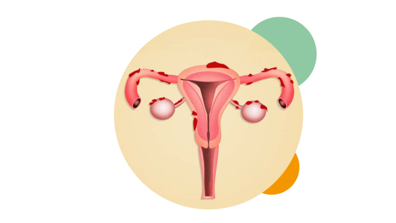 endometriose doença da mulher moderna - Dra Milla Cerqueira - Ginecologista Florianópolis