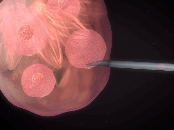 Quantos embriões podem ser transferidos - Dra Mila Cerqueira - Ginecologista Florianópolis